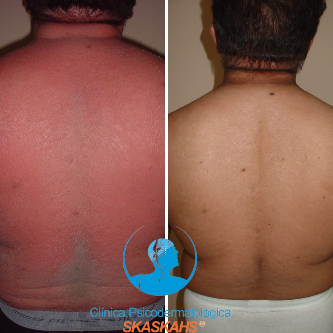Psoriasis en Cuerpo